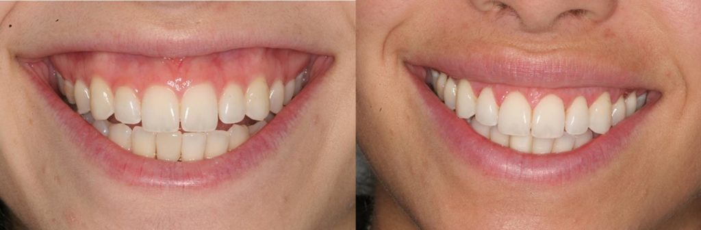 Gummy Smile - Cosmetic Dentist - Oakland County MI